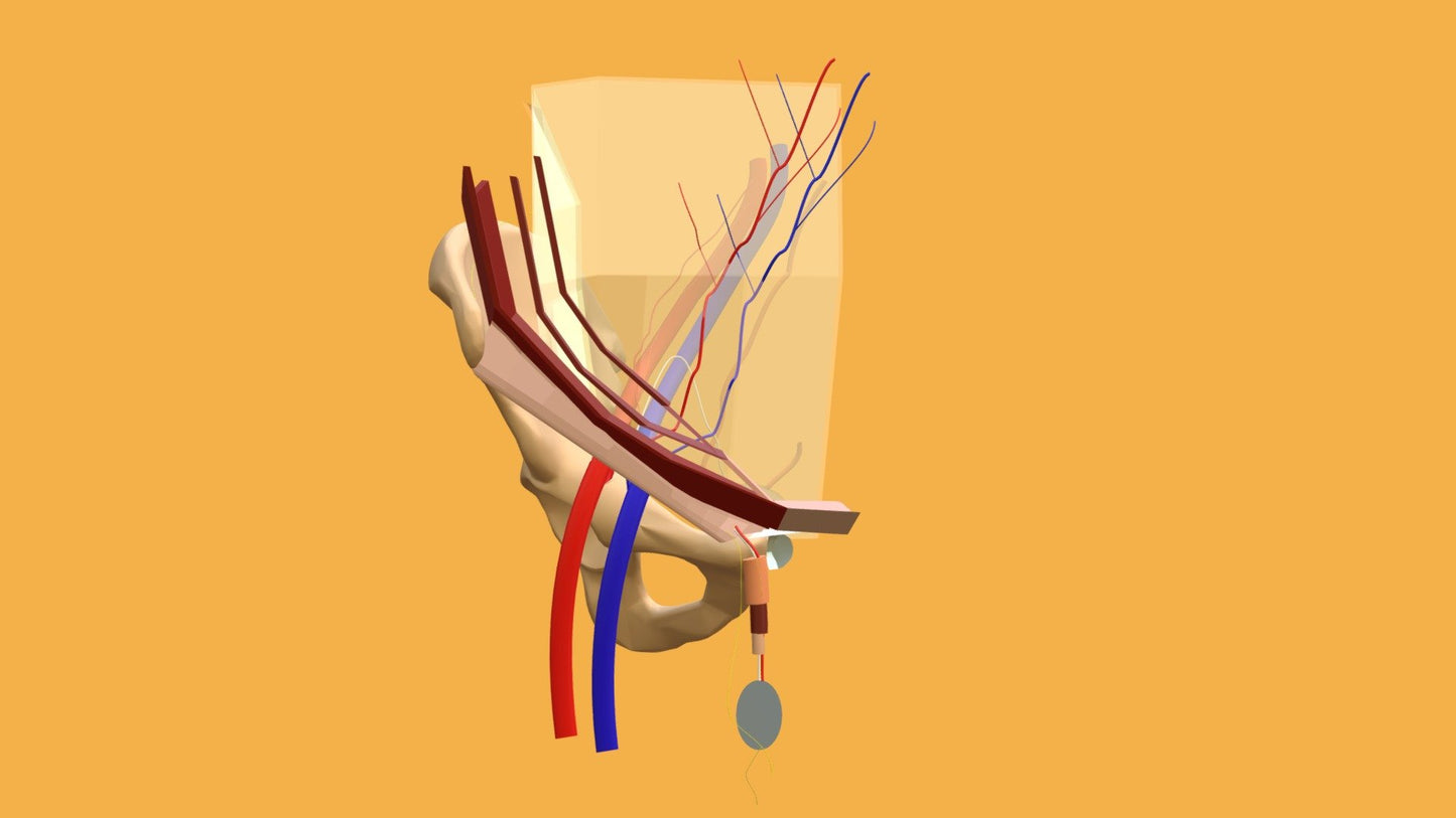 Mesh Inguinal 3D