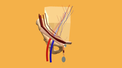 Mesh Inguinal